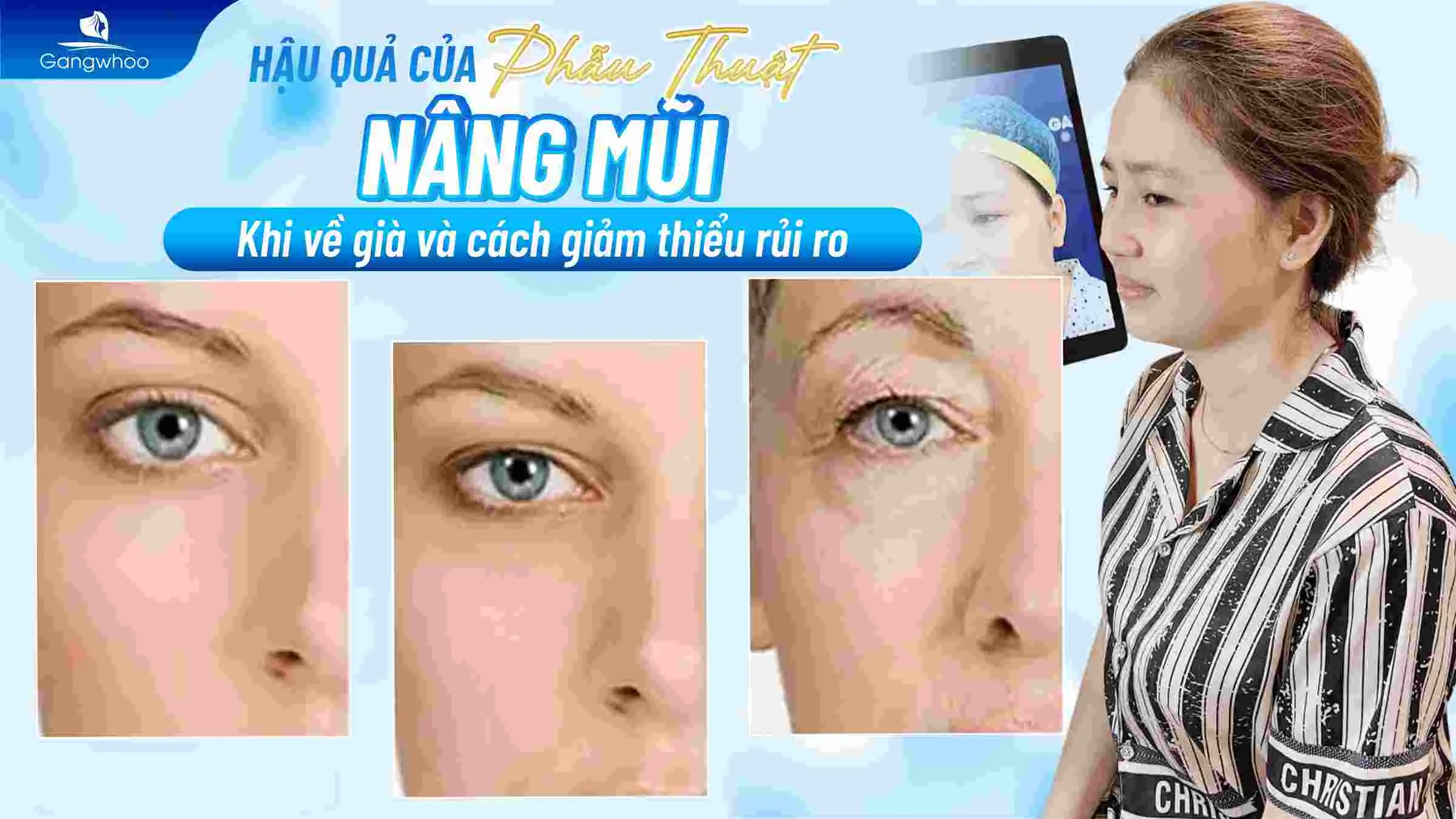 Hậu Quả Của Nâng Mũi Khi Về Già Và Cách Giảm Thiểu Rủi Ro