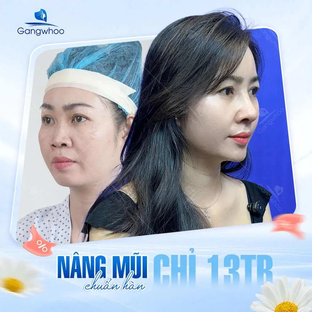 Các loại kẹp nâng mũi phổ biến hiện nay