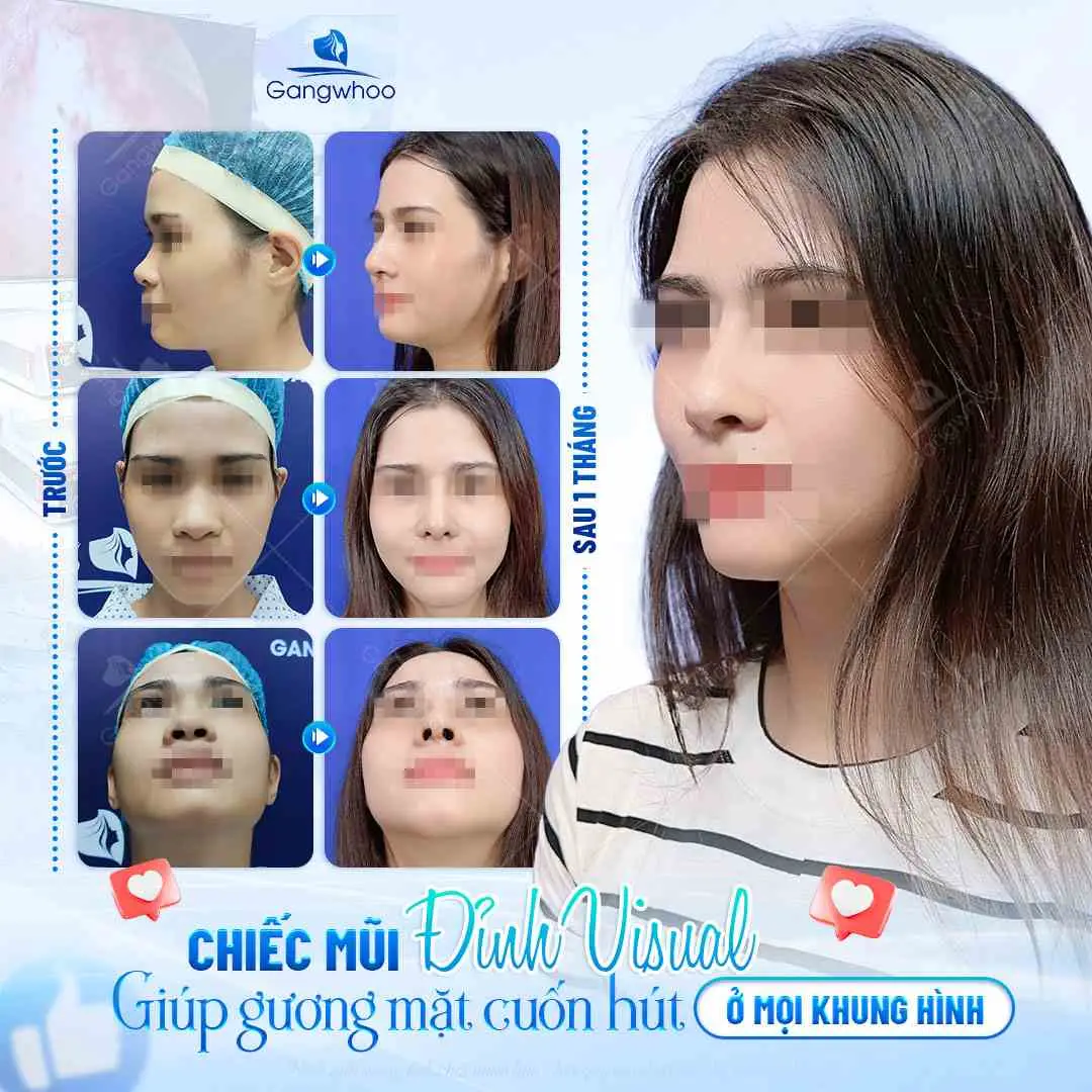 Kẹp nâng mũi có hiệu quả không?