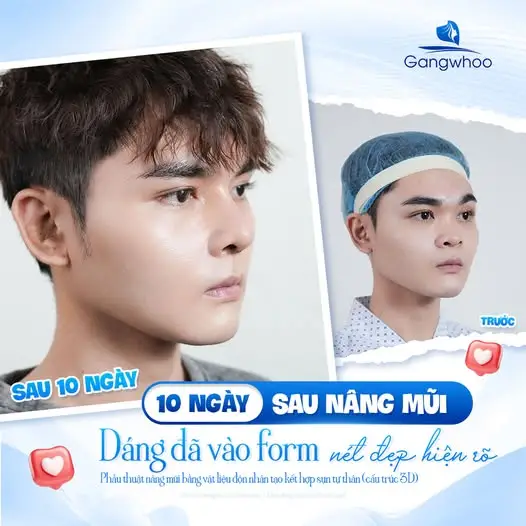 Nâng mũi cấu trúc 4D hoặc 6D