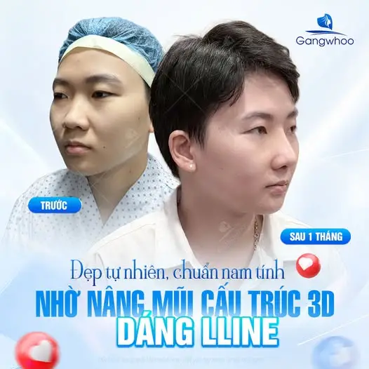 Dáng mũi L-Line cao thanh thoát