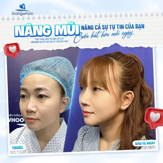 Các phương pháp nâng mũi phù hợp với mặt tròn