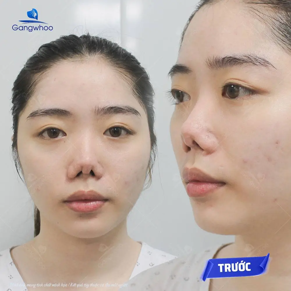 Mũi bị lung lay sau nâng mũi có thể làm lệch hoặc lộ sống