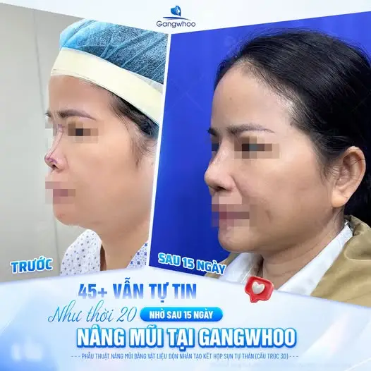 Đặc điểm dáng mũi tẹt và hếch