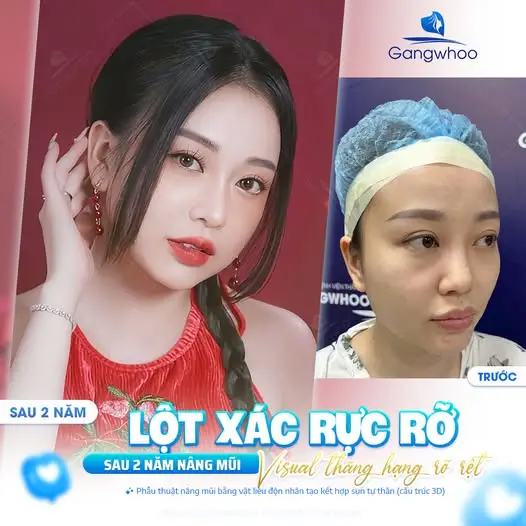 Những dấu hiệu bất thường nếu nổi mụn đầu đen sau nâng mũi