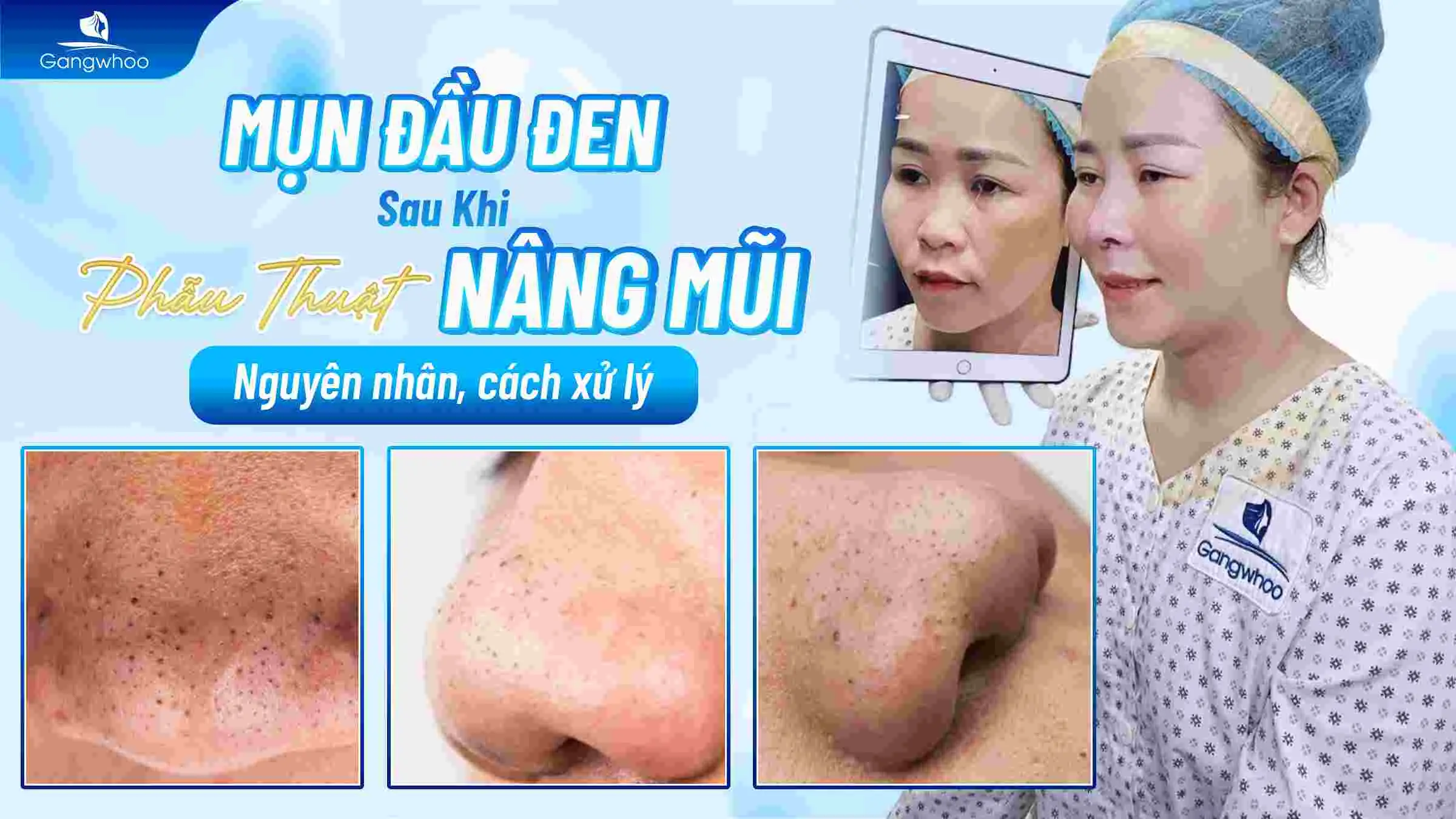 Mụn Đầu Đen Sau Khi Nâng Mũi: Nguyên Nhân, Cách Xử Lý