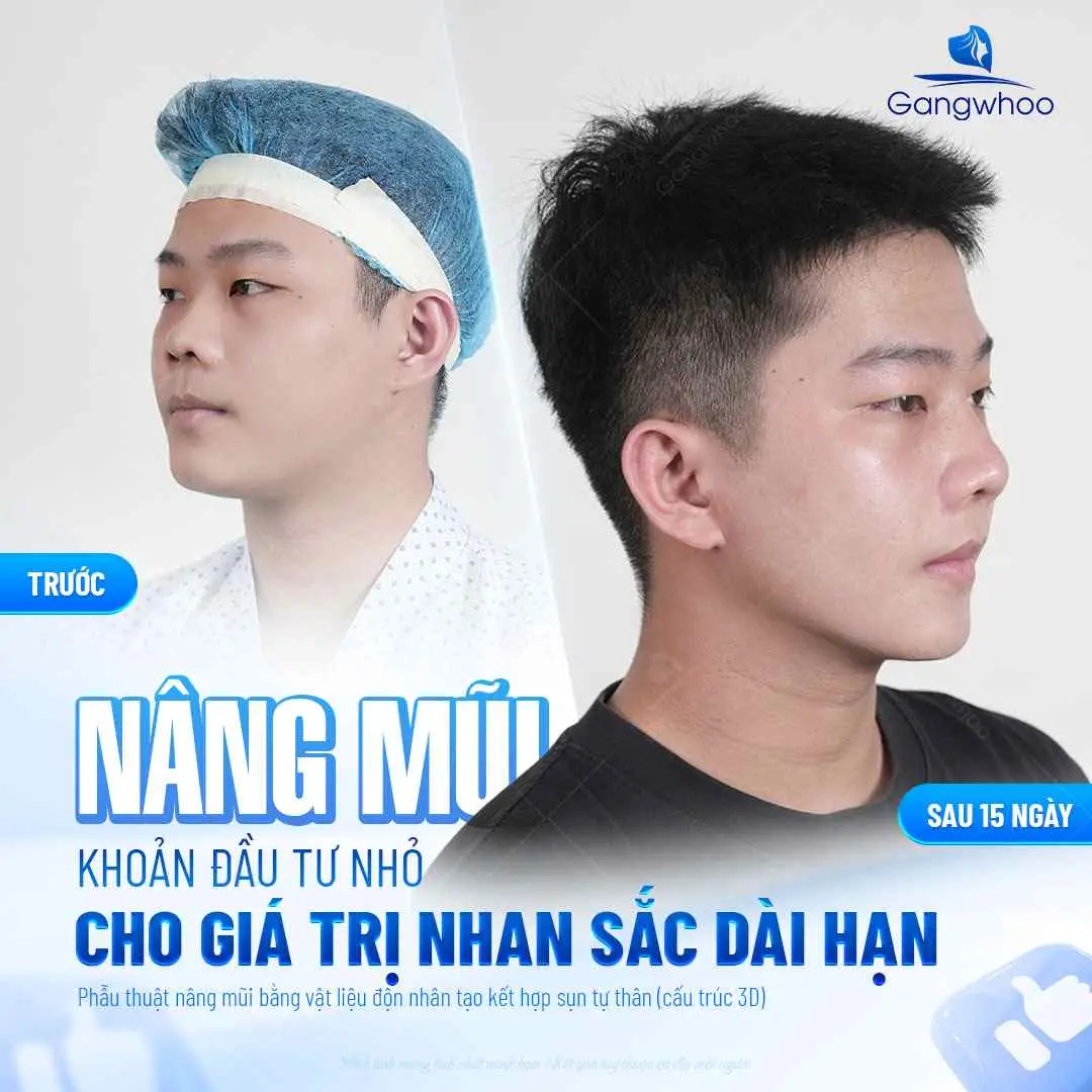 Nâng mũi 1 tháng ăn thịt gà được không theo đánh giá y khoa?