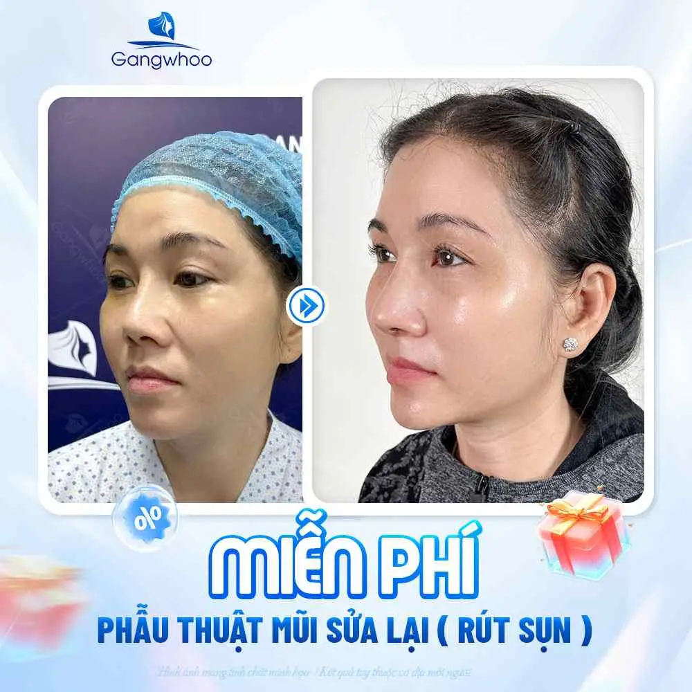 Ăn thịt gà sau nâng mũi có ảnh hưởng gì không?