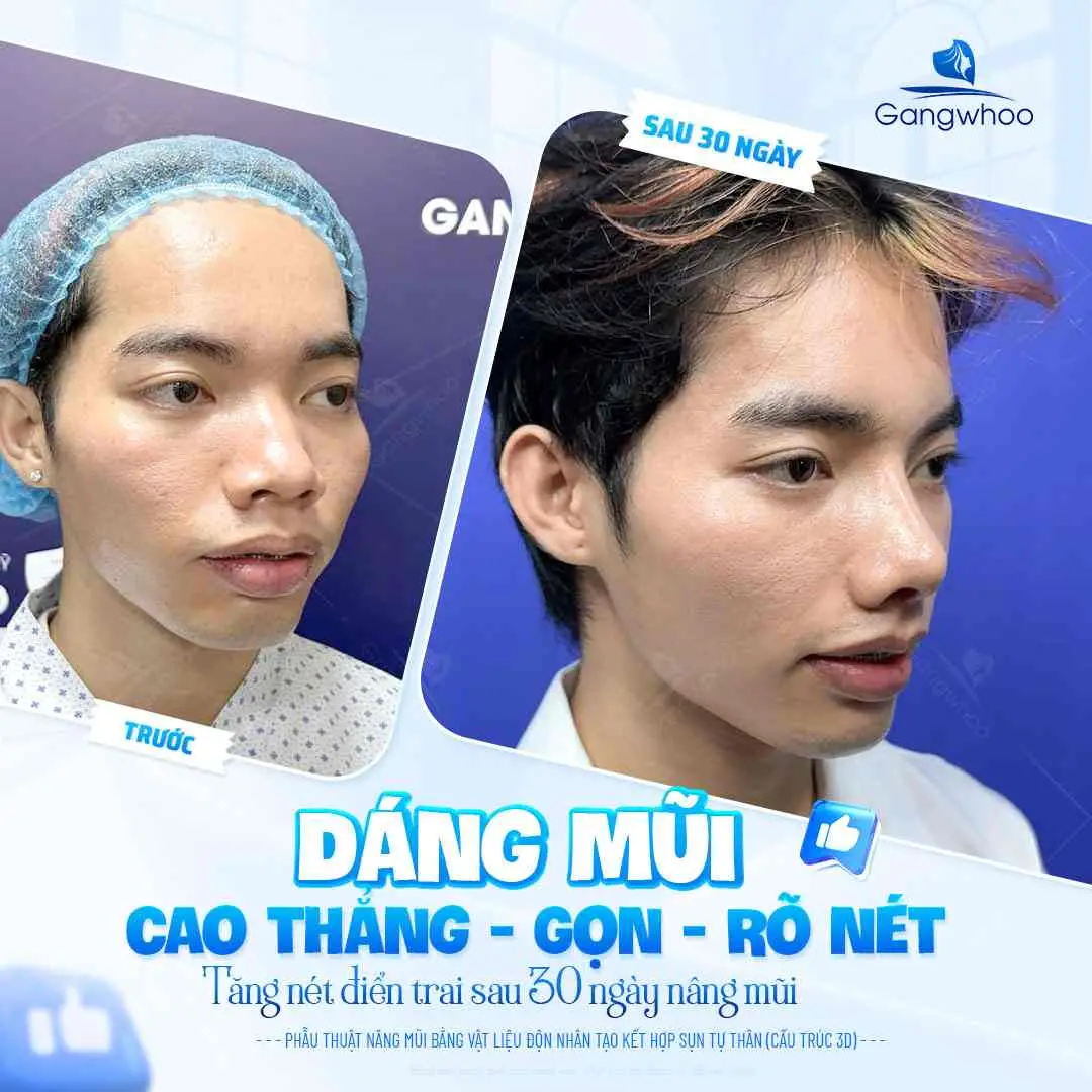 Cách ăn thịt gà an toàn sau nâng mũi 1 tháng