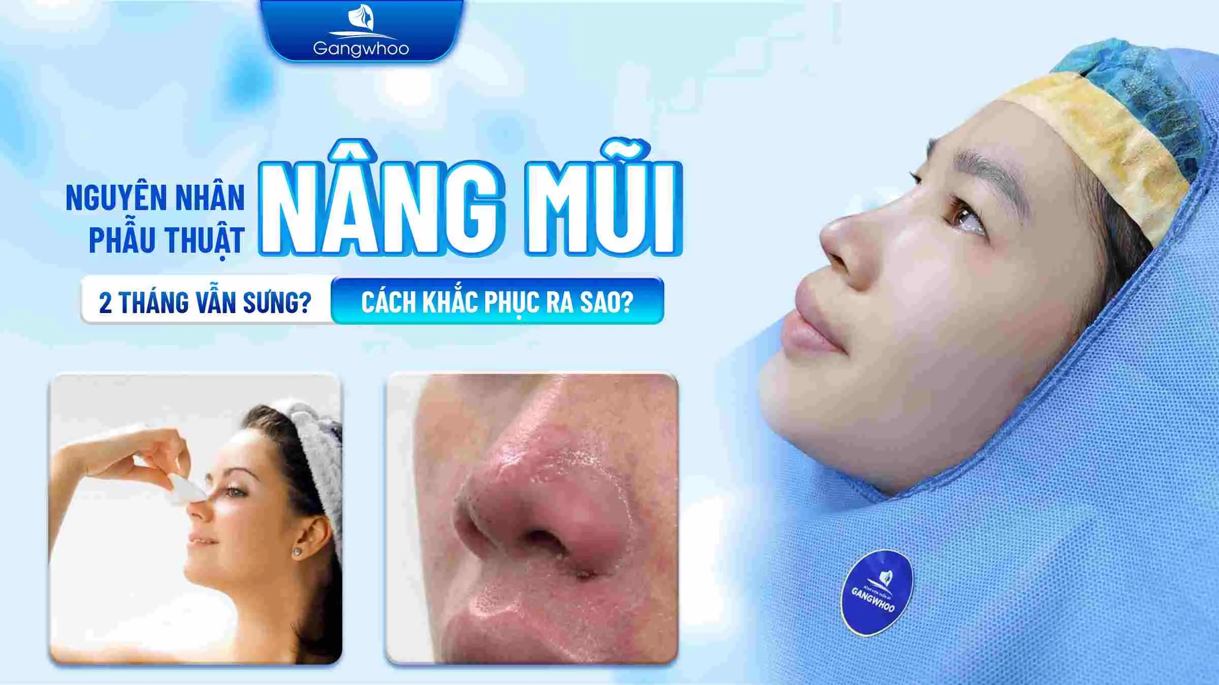 Nguyên Nhân Nâng Mũi 2 Tháng Vẫn Sưng ? Cách Khắc Phục Ra Sao