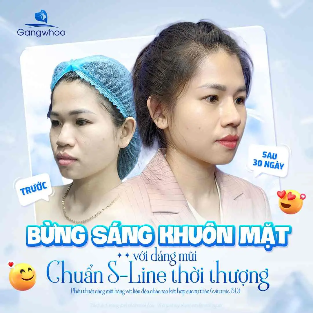 Cách giảm sưng hiệu quả sau nâng mũi 7 ngày