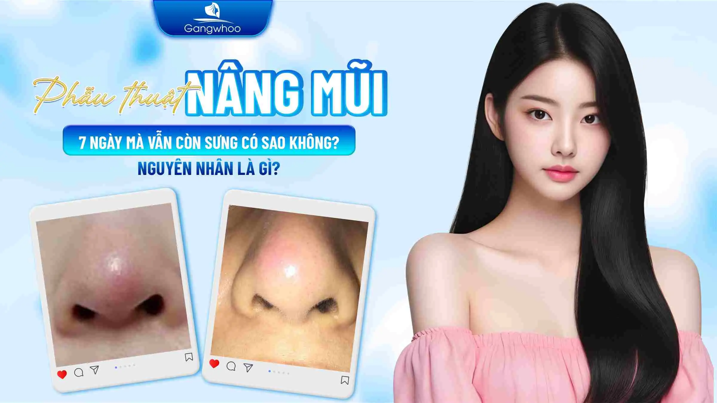 Nâng Mũi 7 Ngày Mà Vẫn Còn Sưng Có Sao Không? Nguyên Nhân Là Gì?