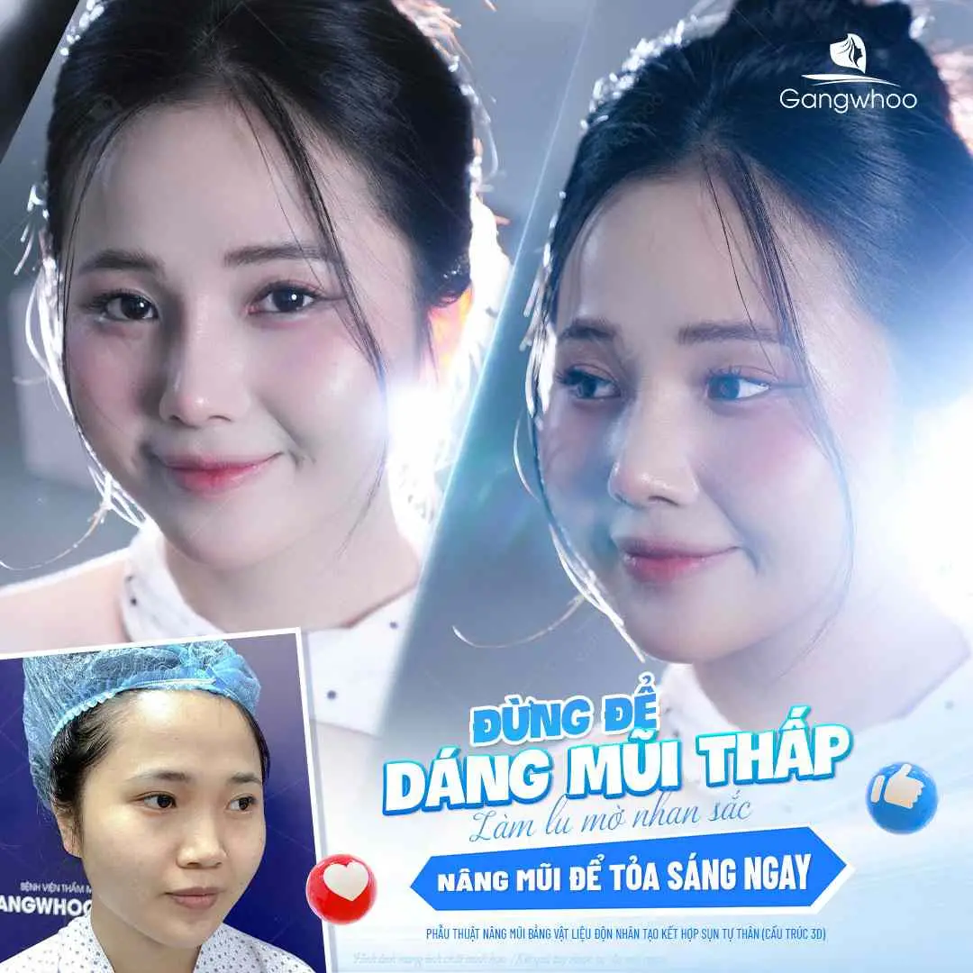 Thành phần bánh bao có ảnh hưởng gì sau nâng mũi