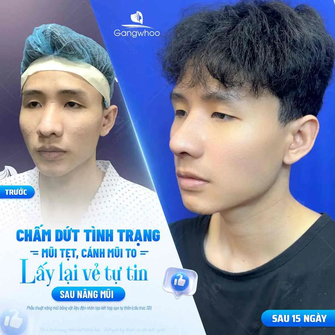 Cách ăn bánh bao an toàn trong giai đoạn hồi phục