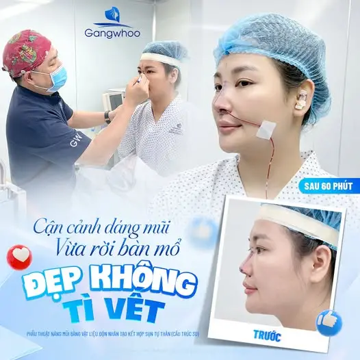 Vì sao bánh tráng dễ gây ảnh hưởng sau nâng mũi?