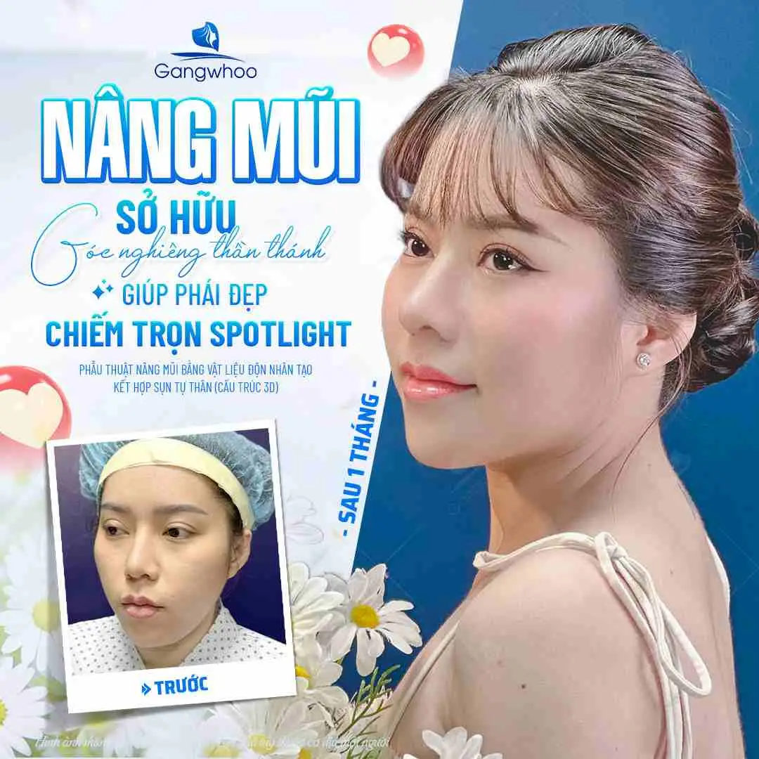 Sau nâng mũi bao lâu thì có thể ăn bánh tráng lại