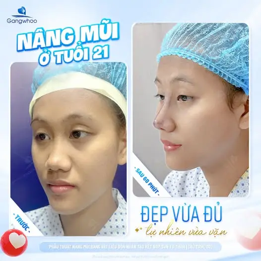 Những ảnh hưởng có thẩ gặp phải nếu ăn bắp ngay sau nâng mũi