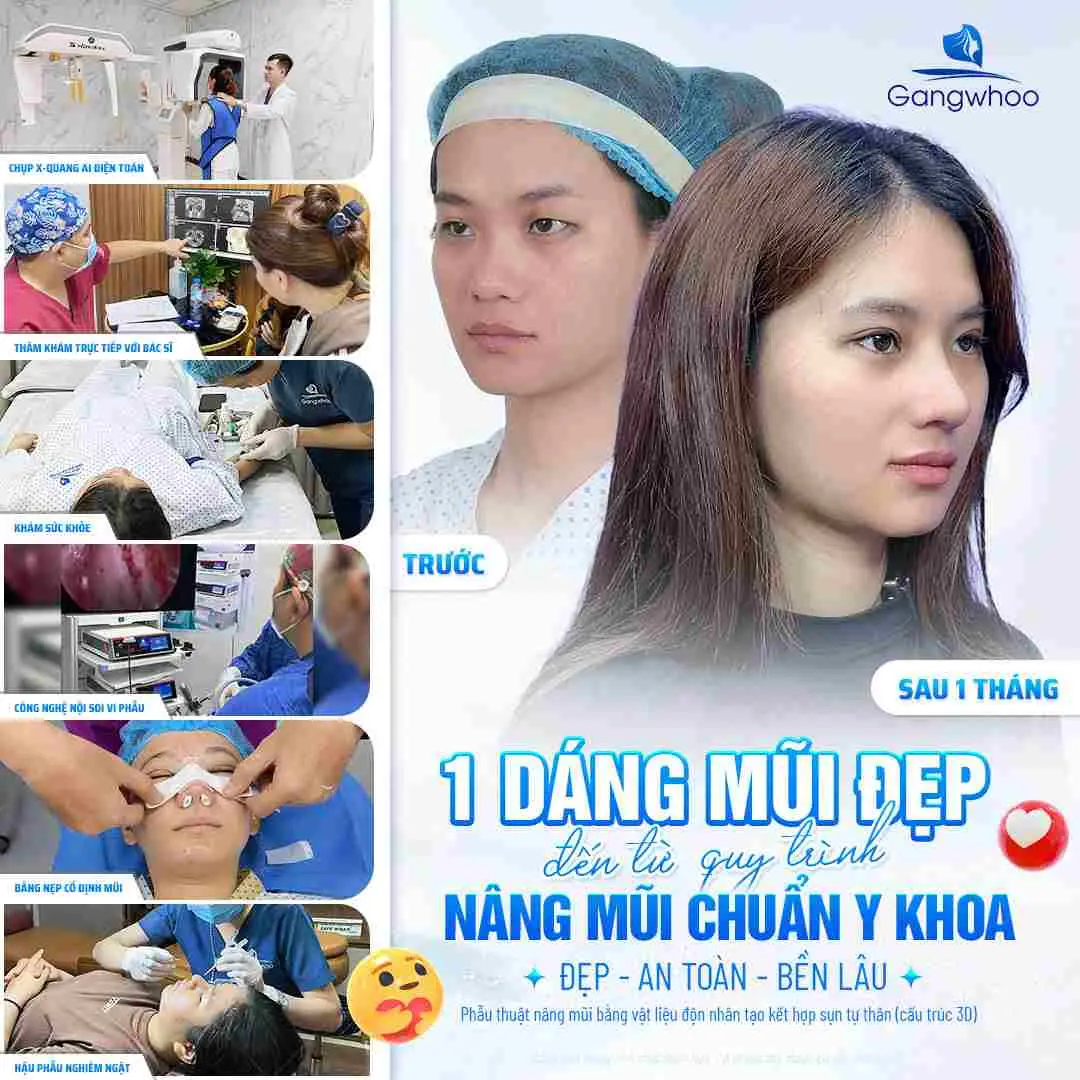 Thời gian phù hợp để ăn bún chả cá sau khi nâng mũi