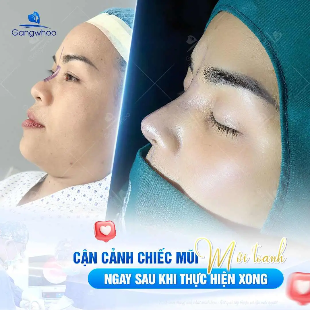 Nâng mũi bao lâu thì được ăn cay trở lại?