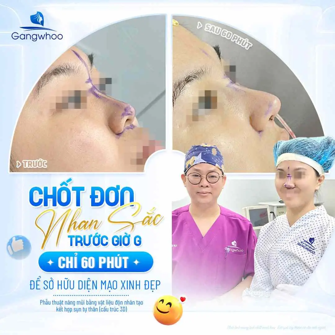 Nâng mũi ăn đập bắp có gây sẹo hay biến chứng không?