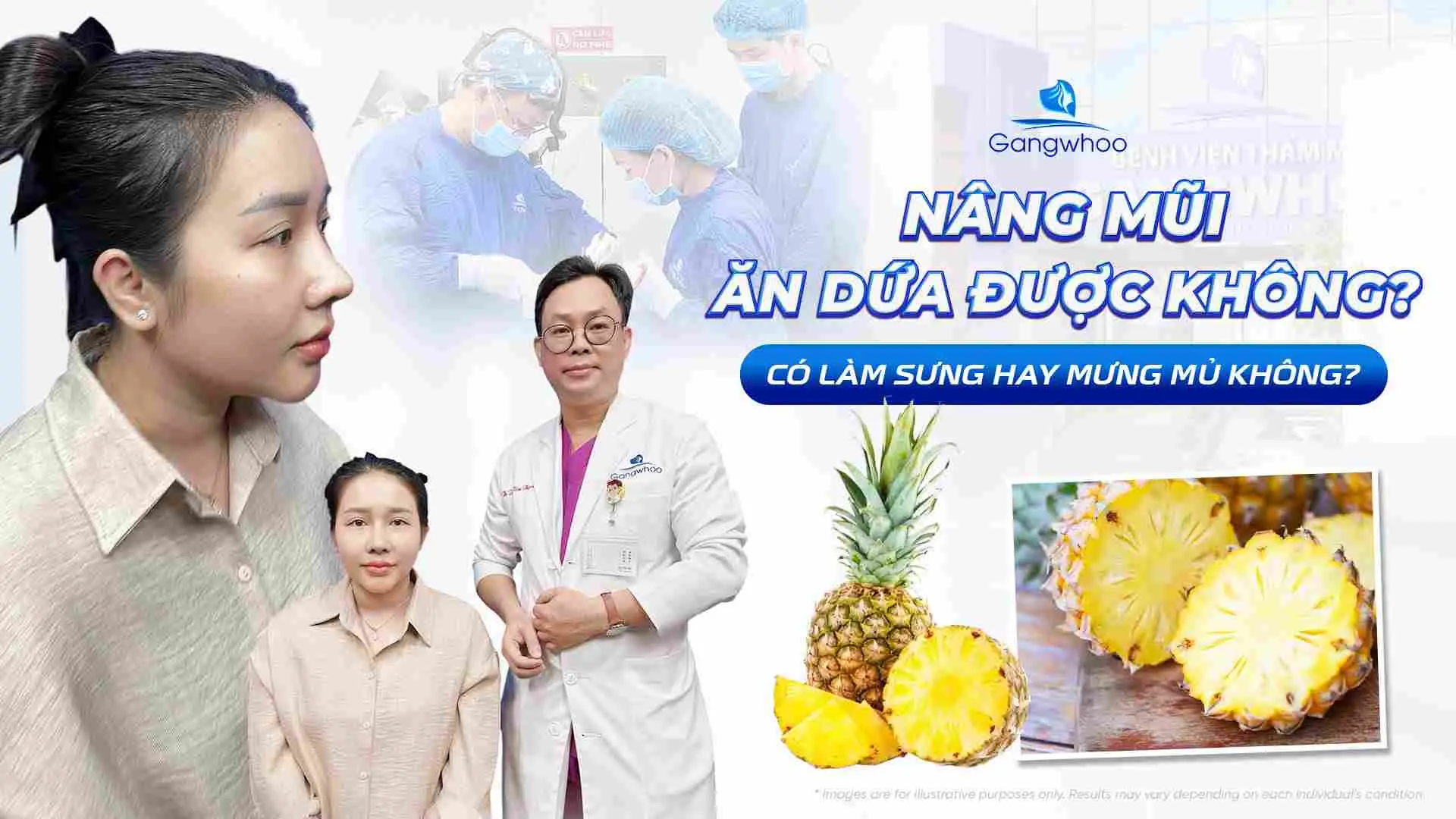 Nâng Mũi Ăn Dứa Được Không? Có Làm Sưng Hay Mưng Mủ Không?