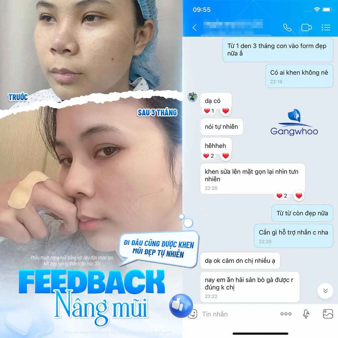 Sau nâng mũi bao lâu thì được ăn hột vịt lộn?