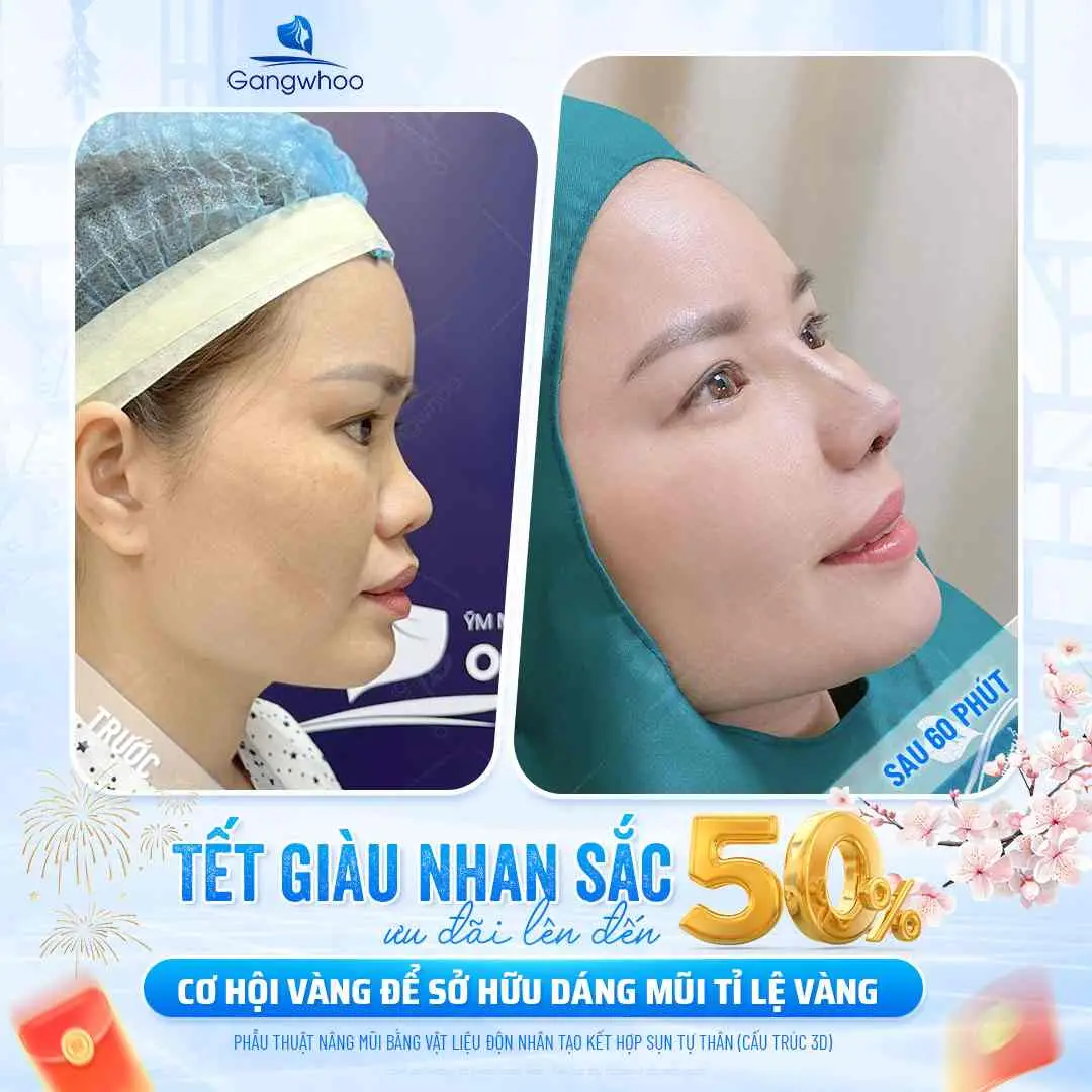 Trường hợp nên ăn khoai lang sau nâng mũi
