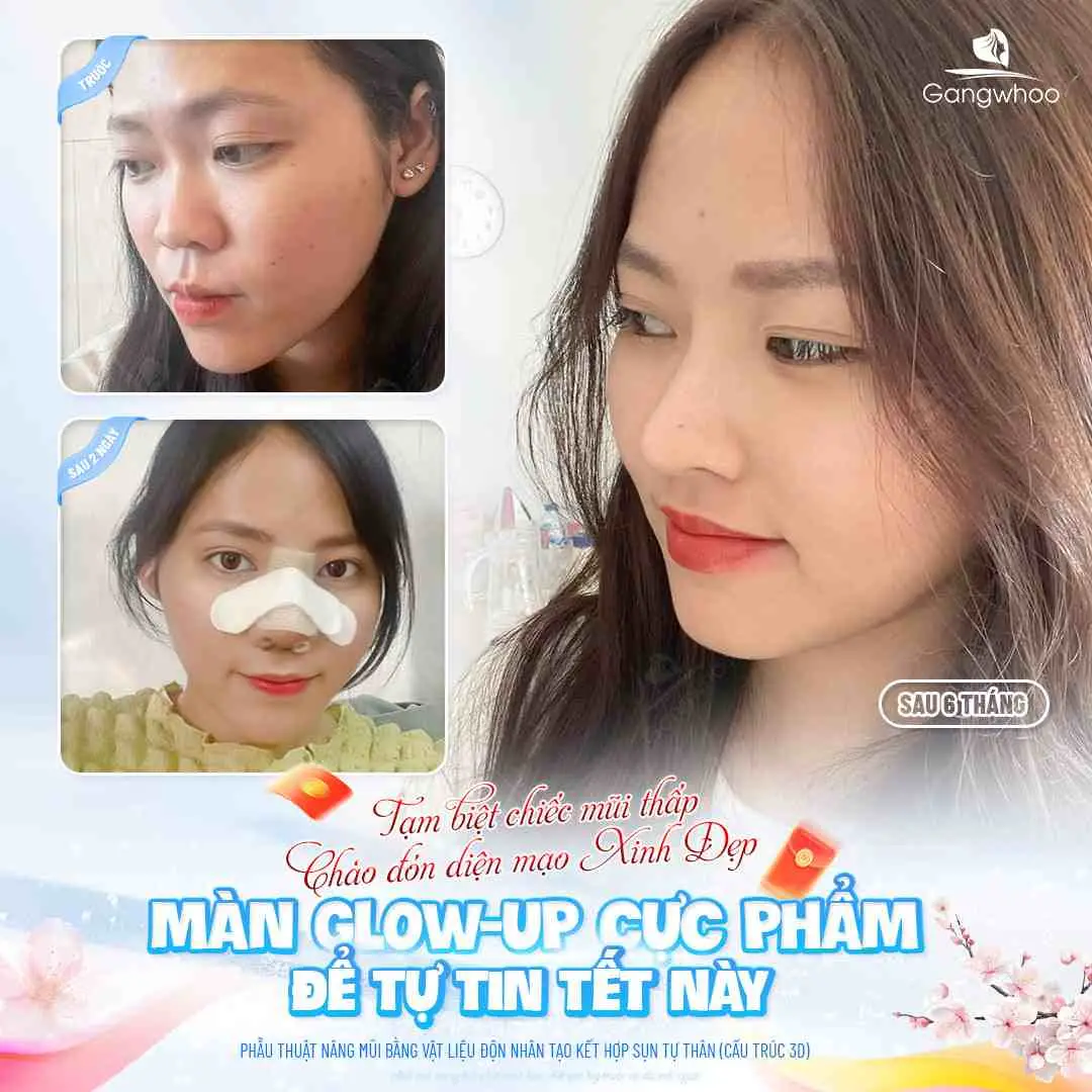 Lưu ý khi ăn khoai lang sau nâng mũi