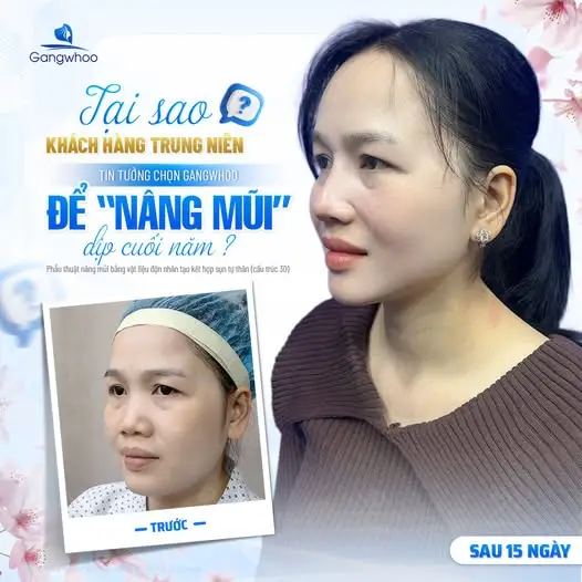 Trường hợp nên kiêng mít sau nâng mũi