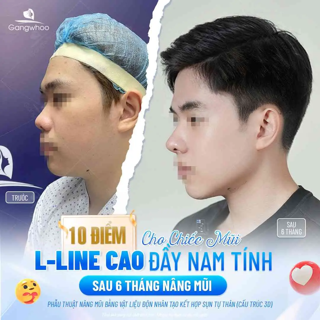 Nâng mũi ăn nước tương có làm mũi lâu lành hoặc để sẹo không?