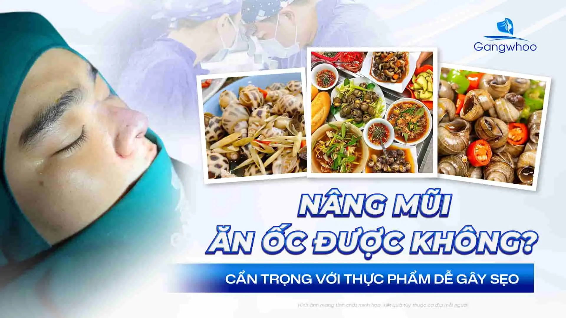 Nâng Mũi Ăn Ốc Được Không? Cẩn Trọng Với Thực Phẩm Dễ Gây Sẹo