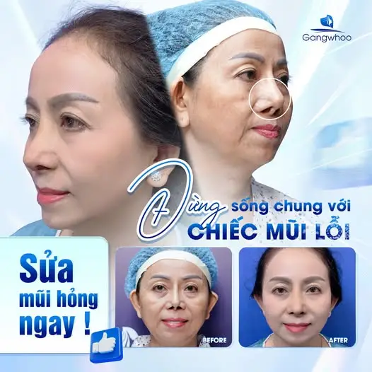 Những biến chứng có thể gặp phải nếu ăn ốc sớm sau khi nâng mũi