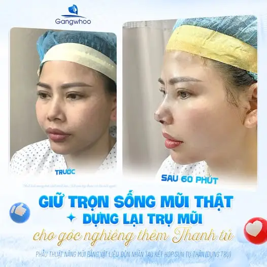 Bao lâu sau nâng mũi thì có thể ăn ốc trở lại?
