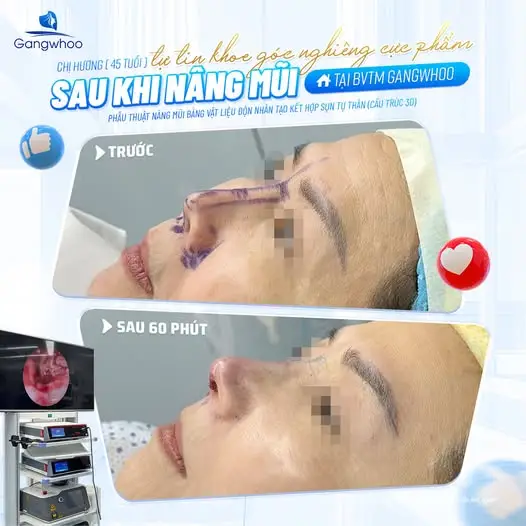 Trường hợp nào sau nâng mũi có thể ăn rau nhút?