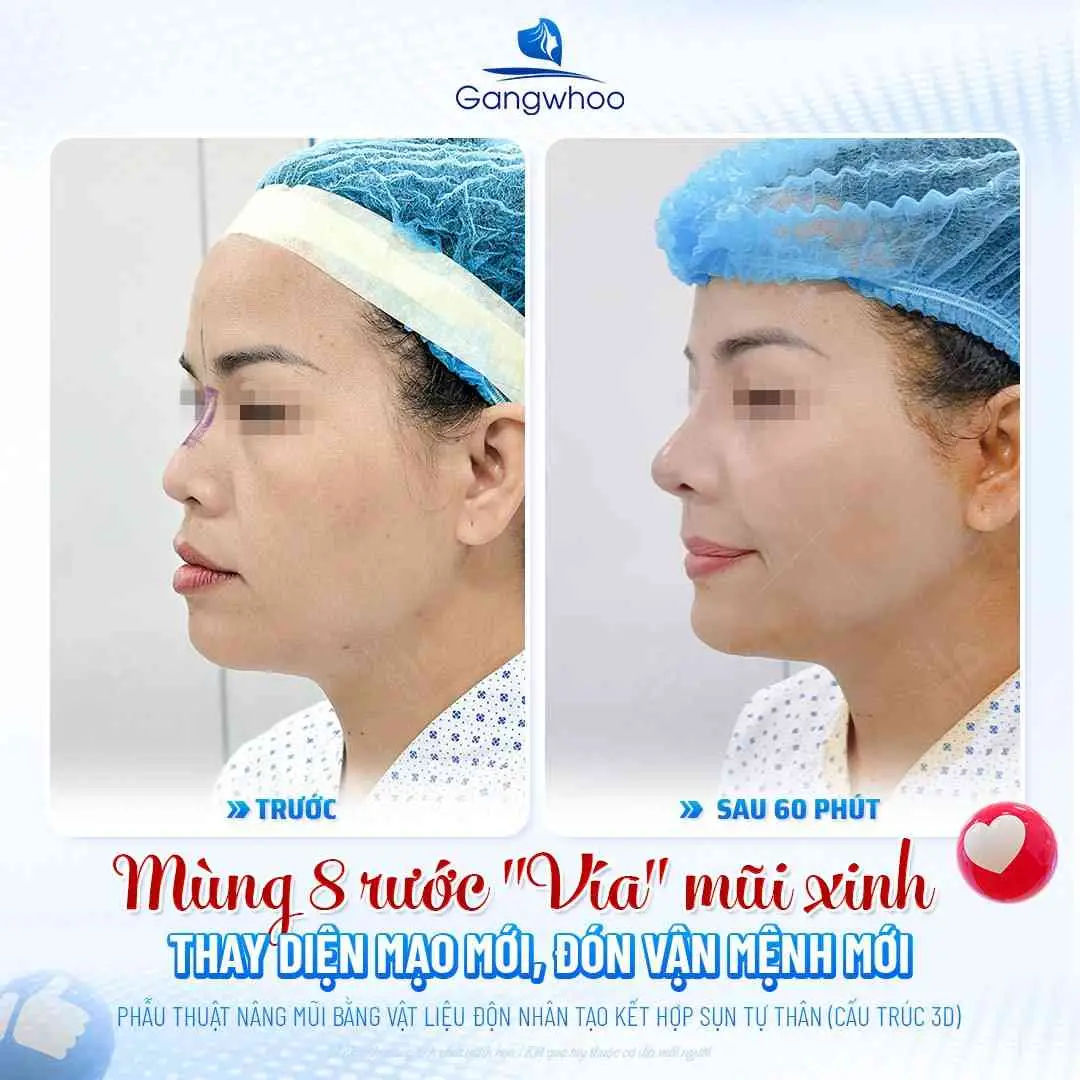 Bao lâu sau nâng mũi thì có thể ăn thịt thỏ an toàn?