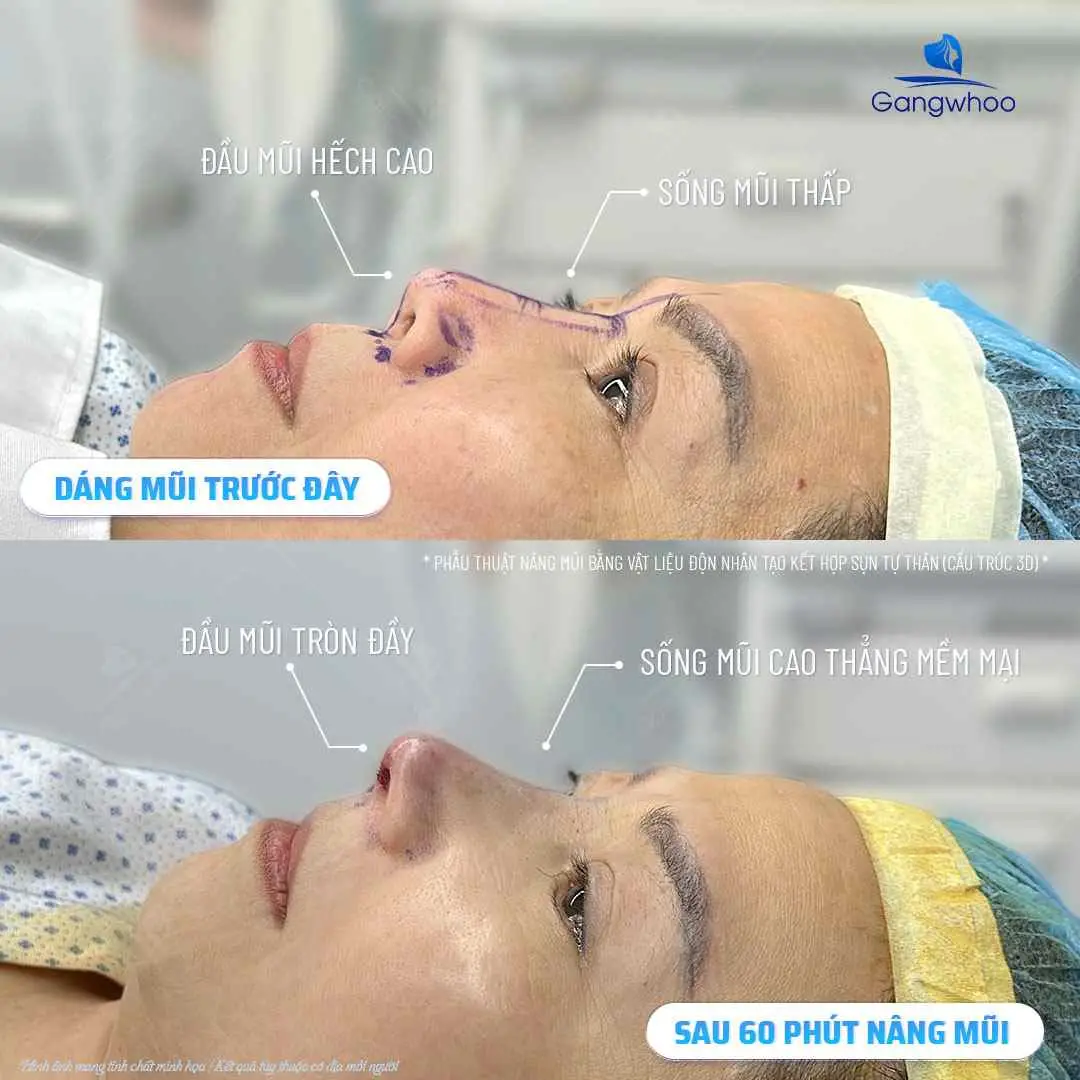 Tại sao cần kiêng thịt vịt trong các tuần đầu sau nâng mũi?
