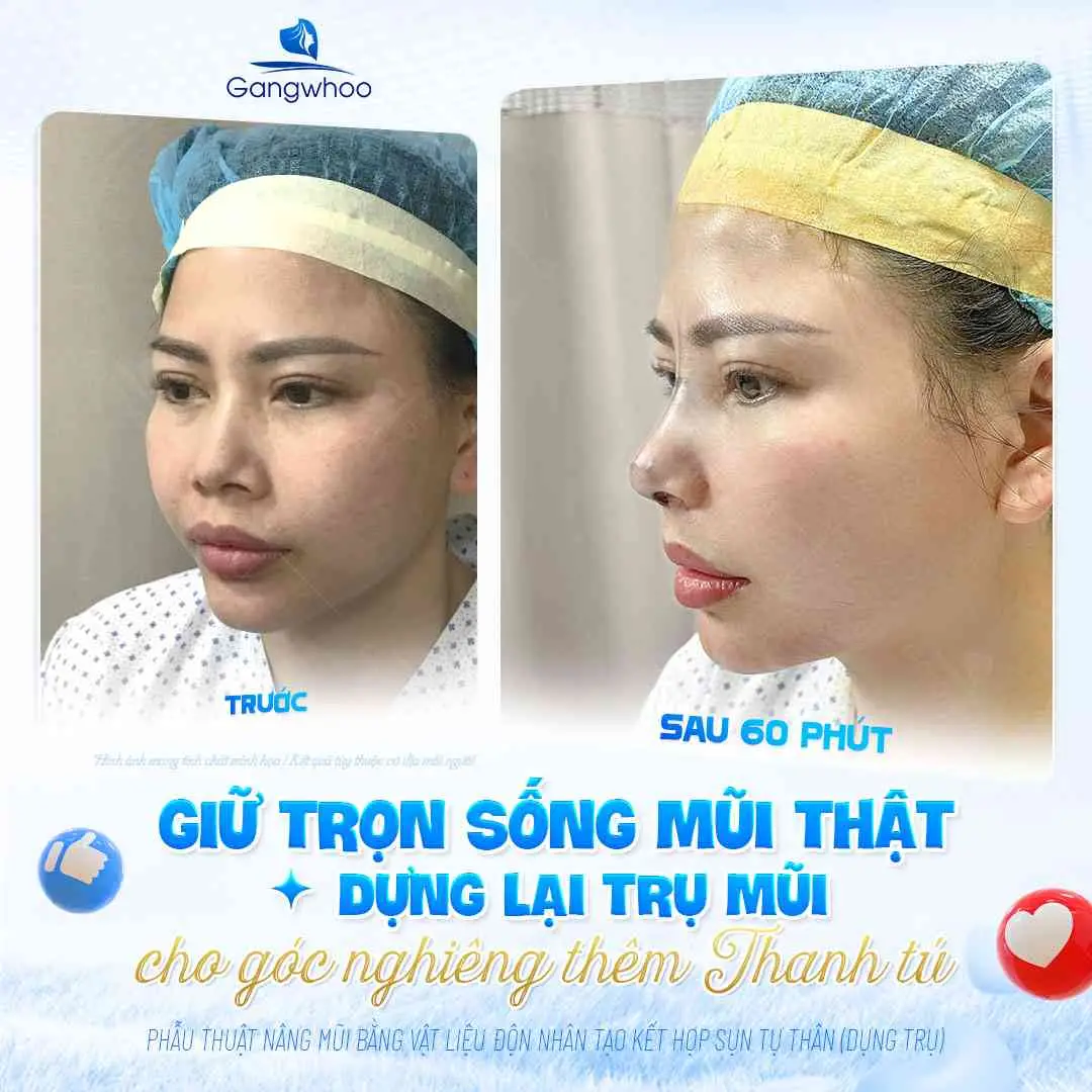 Lưu ý khi bổ sung trứng trong tuần đầu sau nâng mũi