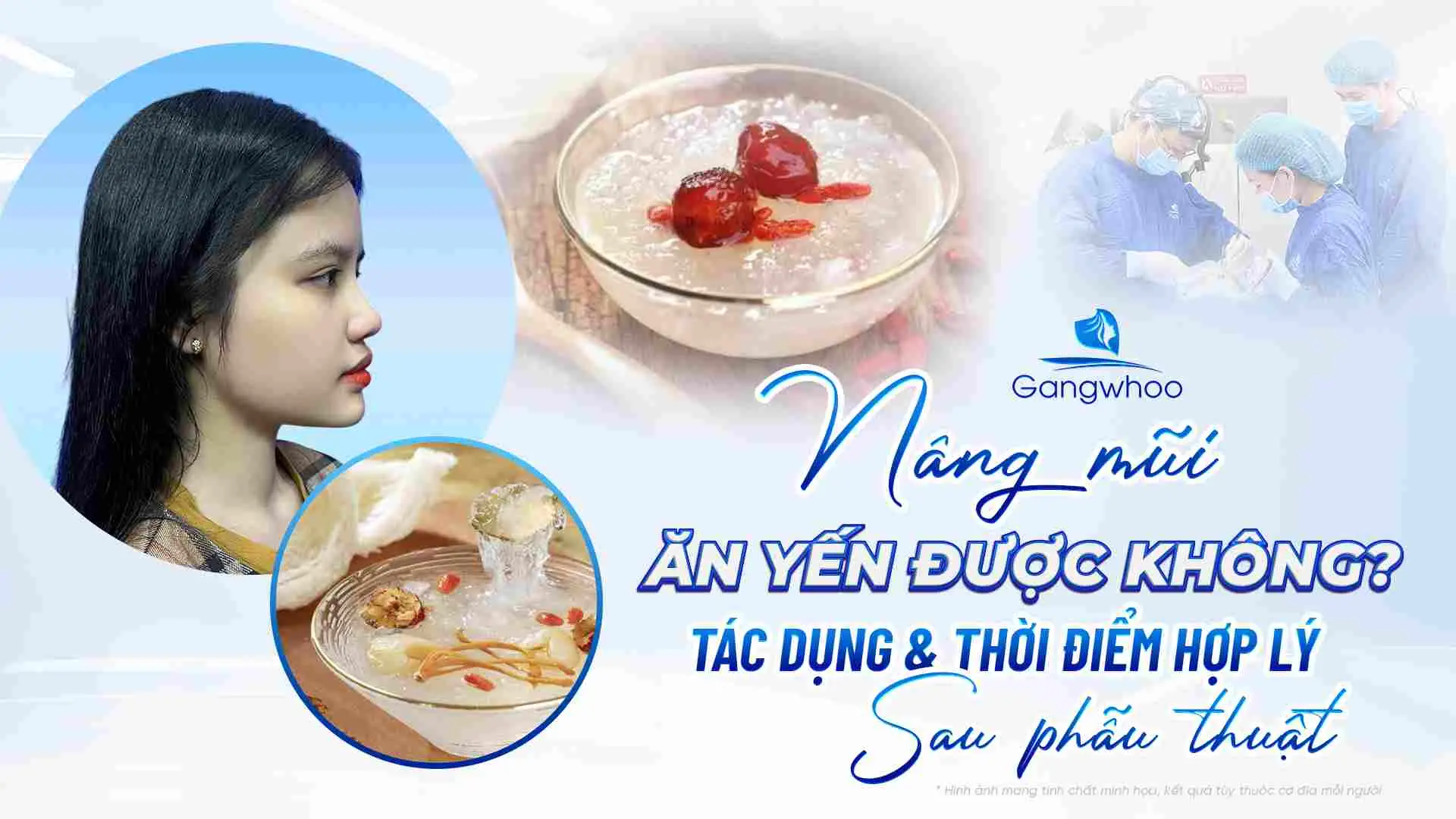 Nâng Mũi Ăn Yến Được Không? Tác Dụng & Thời Điểm Hợp Lý Sau Phẫu Thuật