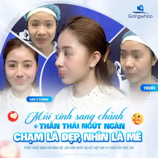 Khi nào nên bắt đầu ăn yến sau nâng mũi?