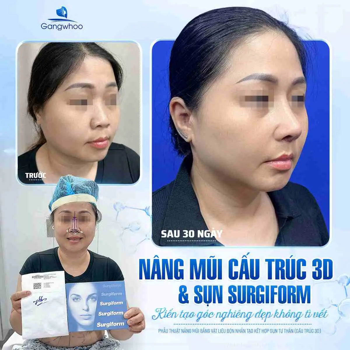 Sau nâng mũi bao lâu thì có thể tập gym lại