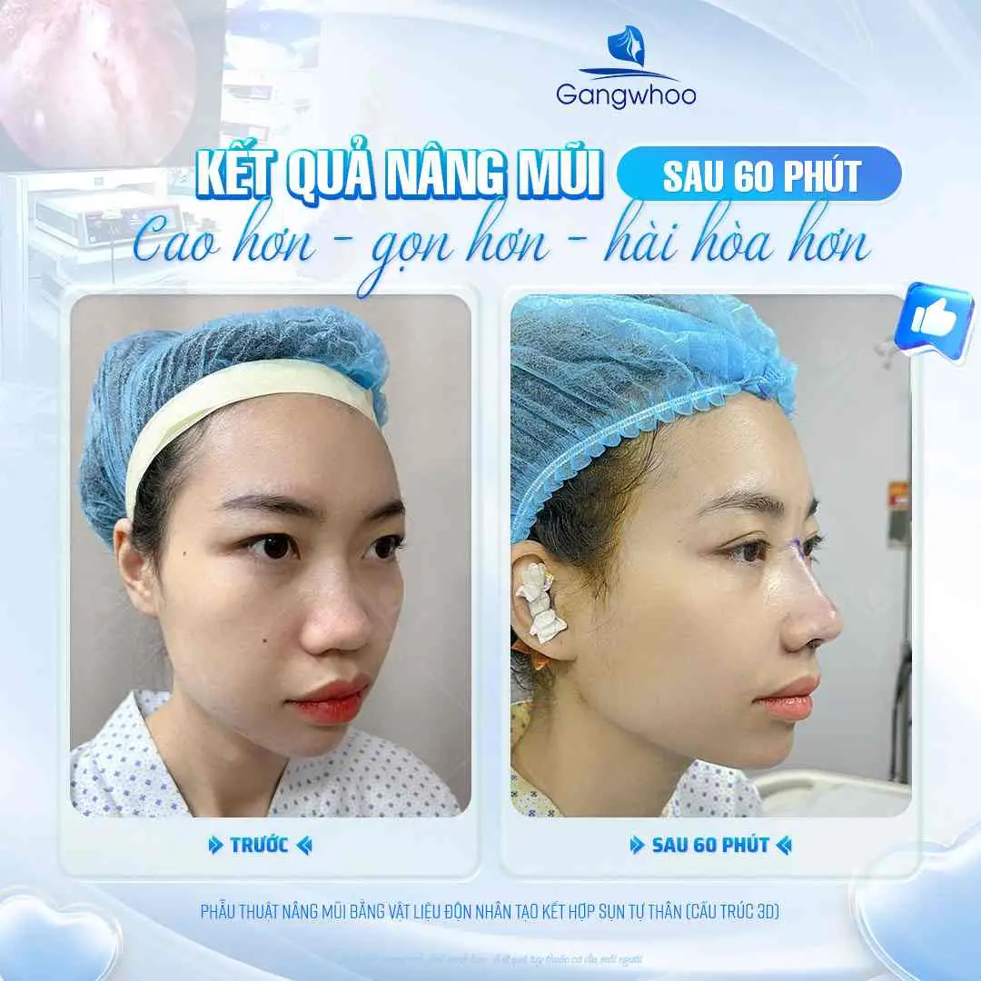 Nâng mũi bao lâu thì được ăn rau muống?