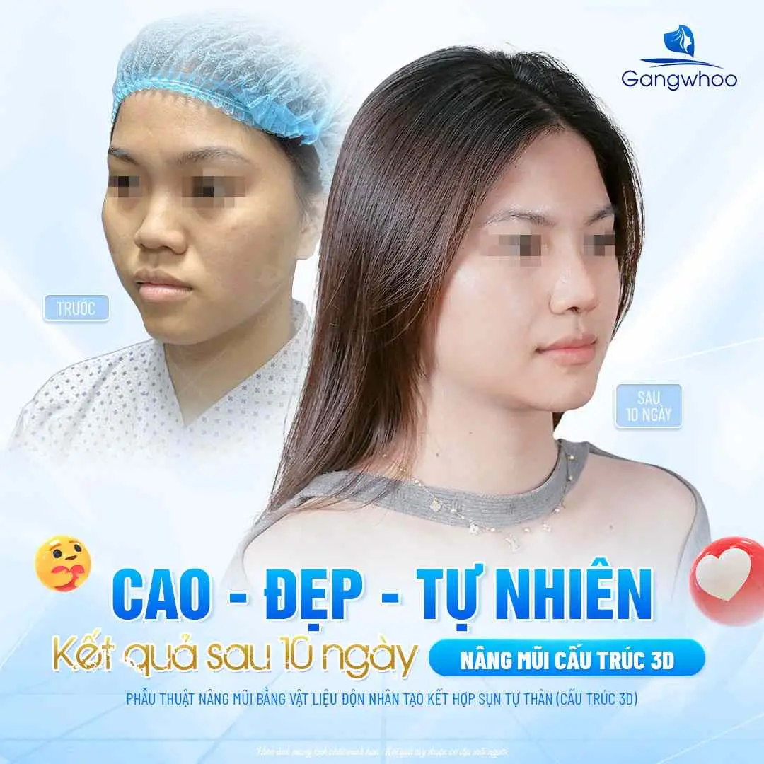 Nâng mũi bao lâu được dưỡng da?
