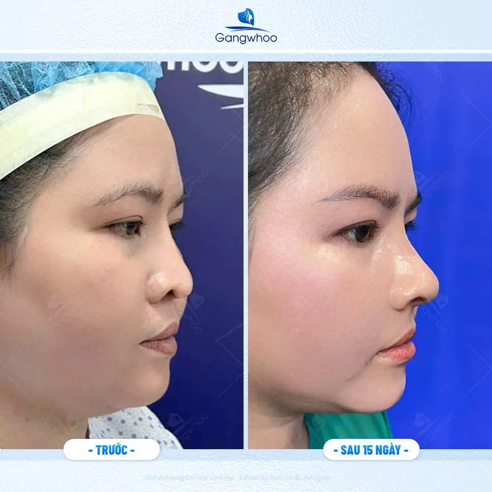 Quy tắc dưỡng da an toàn sau nâng mũi