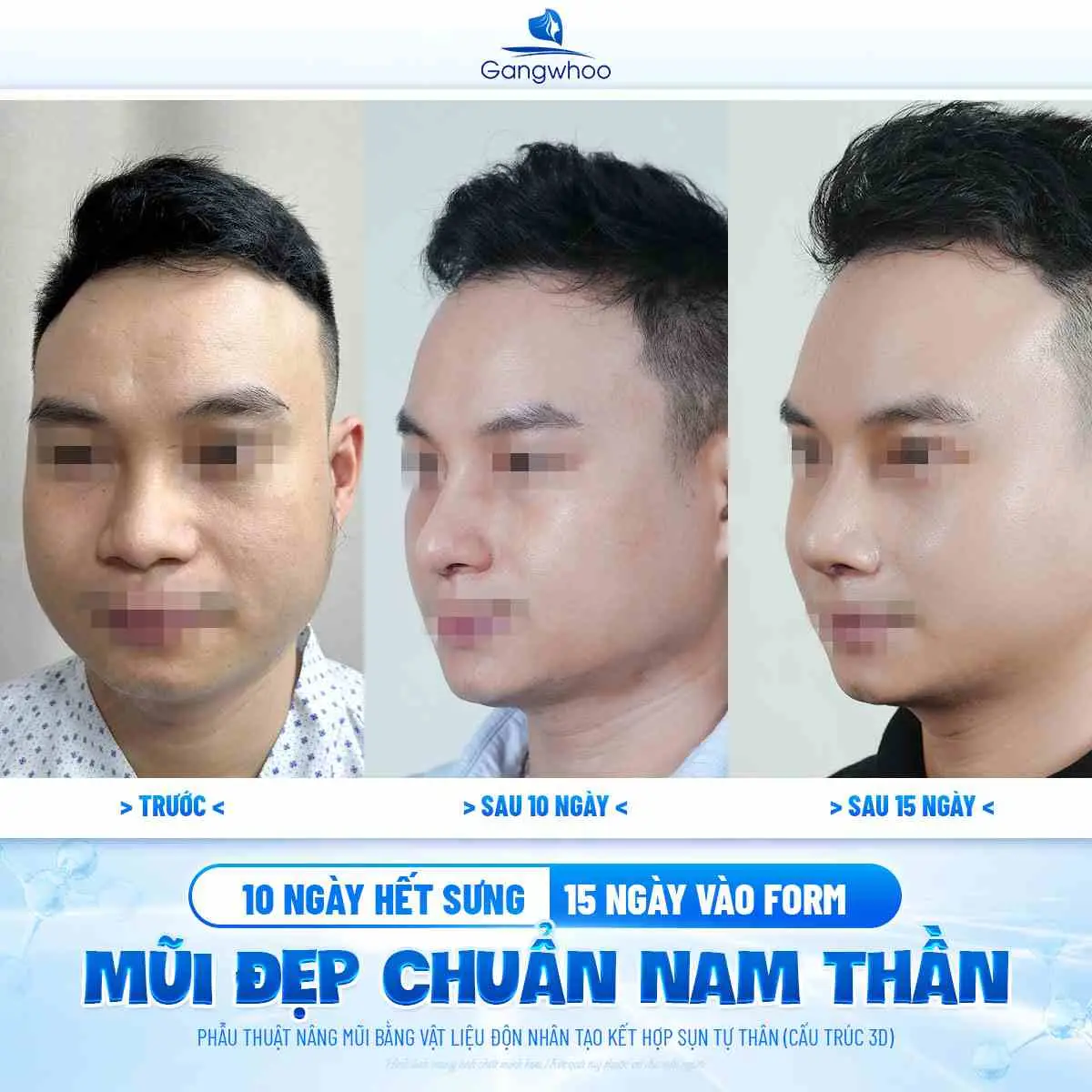 Khoảng thời gian nên kiêng thuốc lá sau nâng mũi