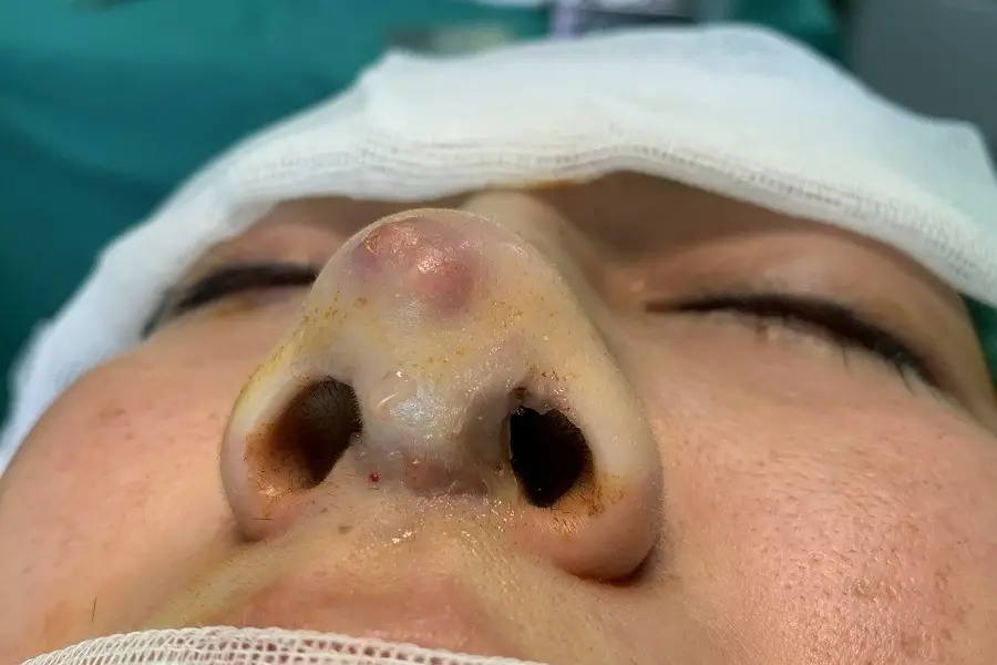 Những dấu hiệu của tình trạng lộ sống mũi sau khi nâng