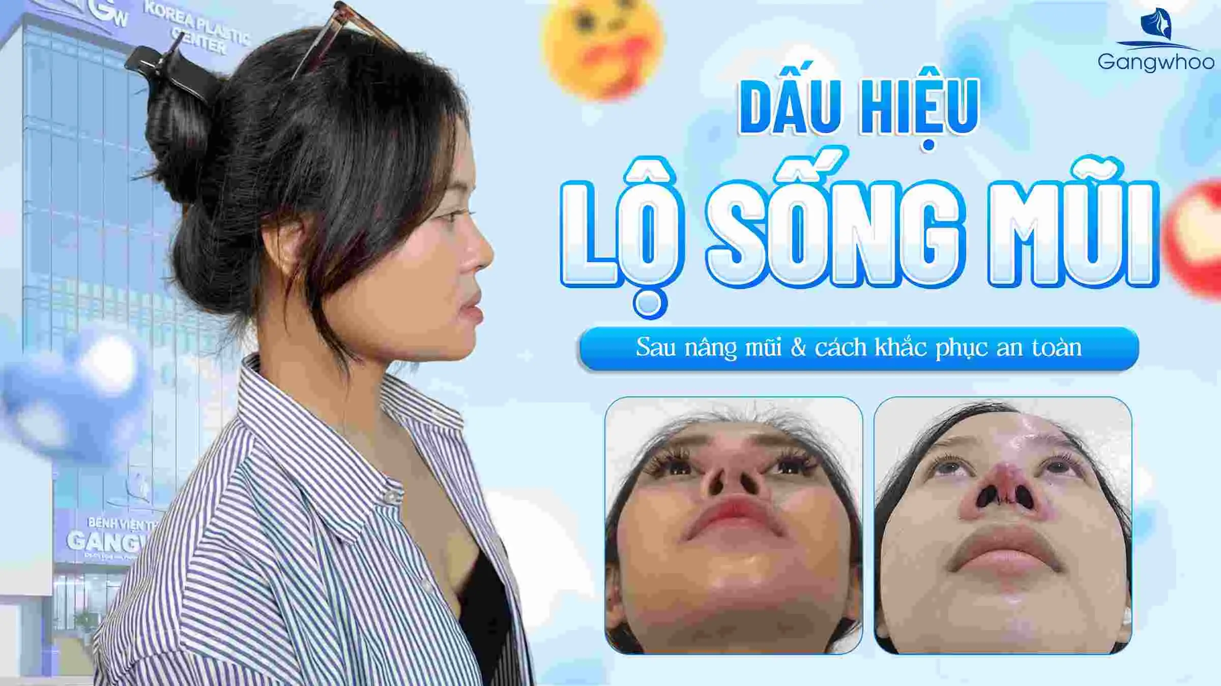 Dấu Hiệu Lộ Sống Mũi Sau Nâng Mũi & Cách Khắc Phục An Toàn