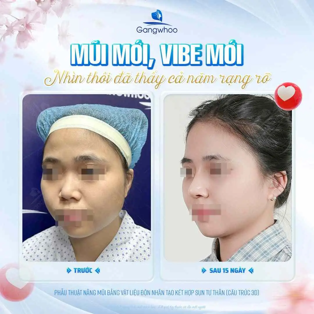 Sau nâng mũi bao lâu thì đi làm được?
