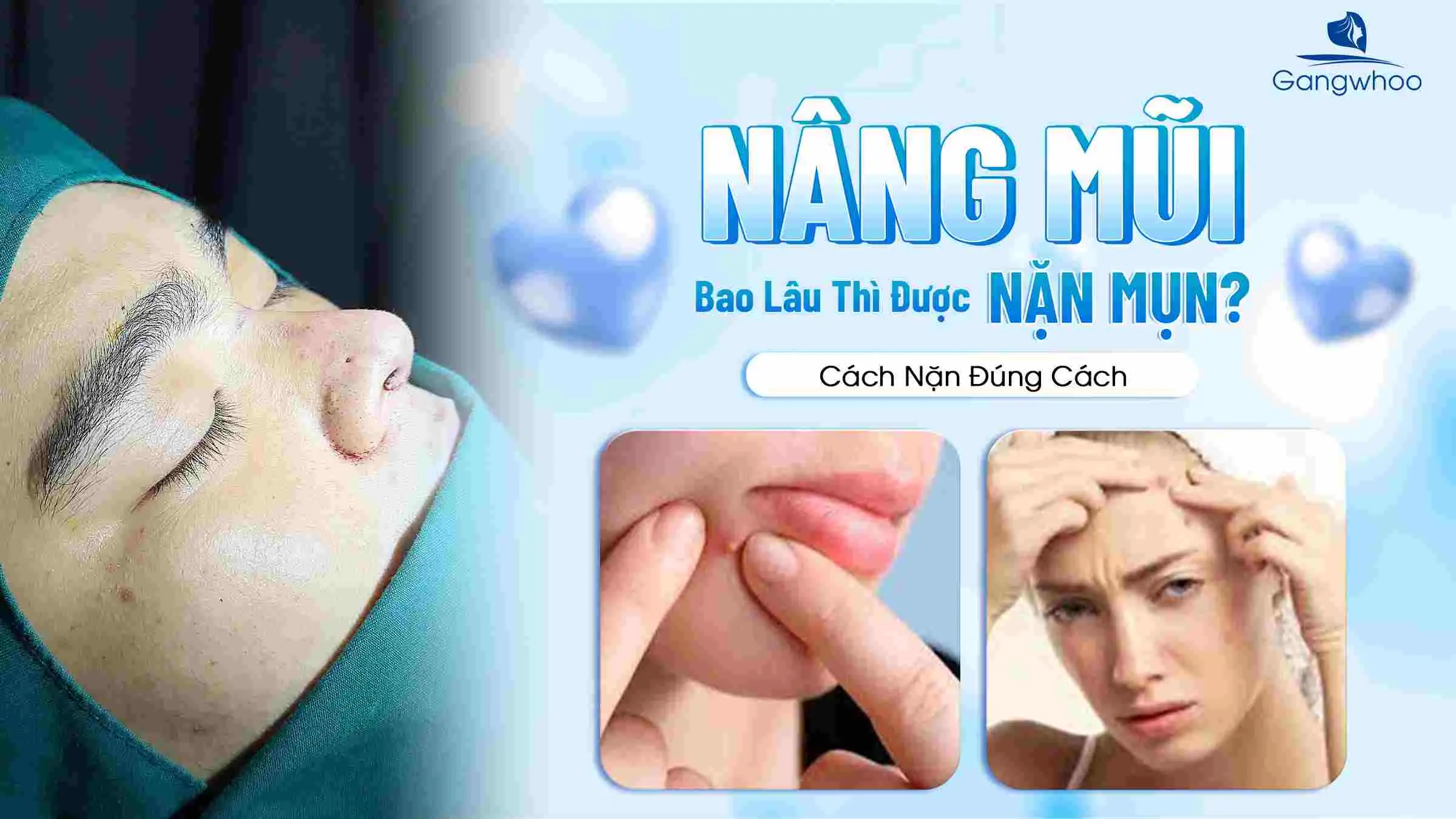 Nâng Mũi Bao Lâu Thì Được Nặn Mụn? Cách Nặn Đúng Cách