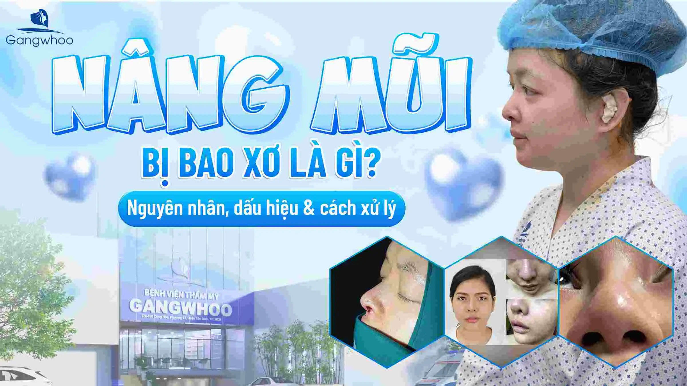 Nâng Mũi Bị Bao Xơ Là Gì? Nguyên Nhân, Dấu Hiệu & Cách Xử Lý