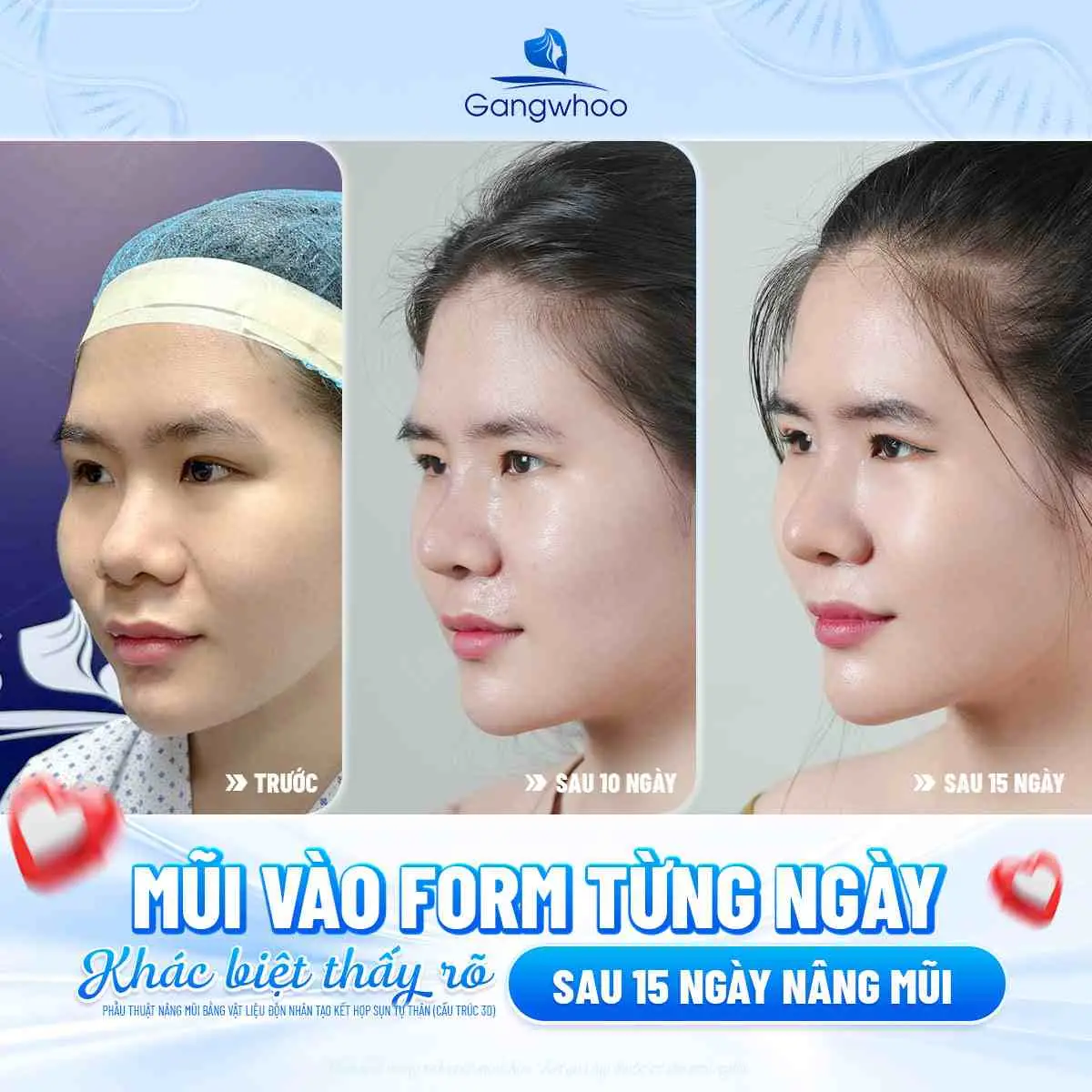 Nâng mũi tự nhiên đúng form sẽ tránh được những tác hại
